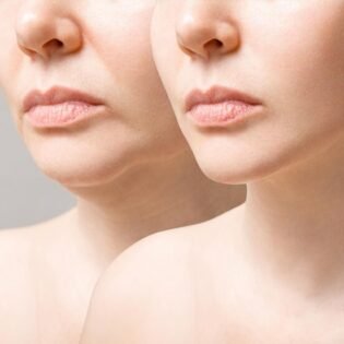 double chin reduction